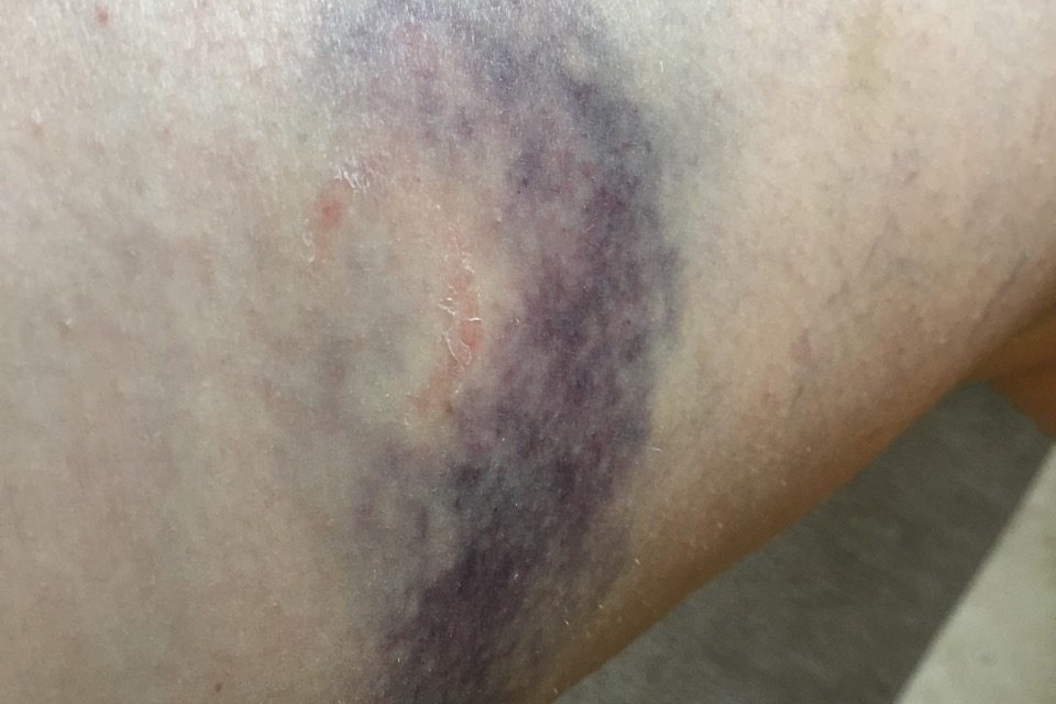 Bruise